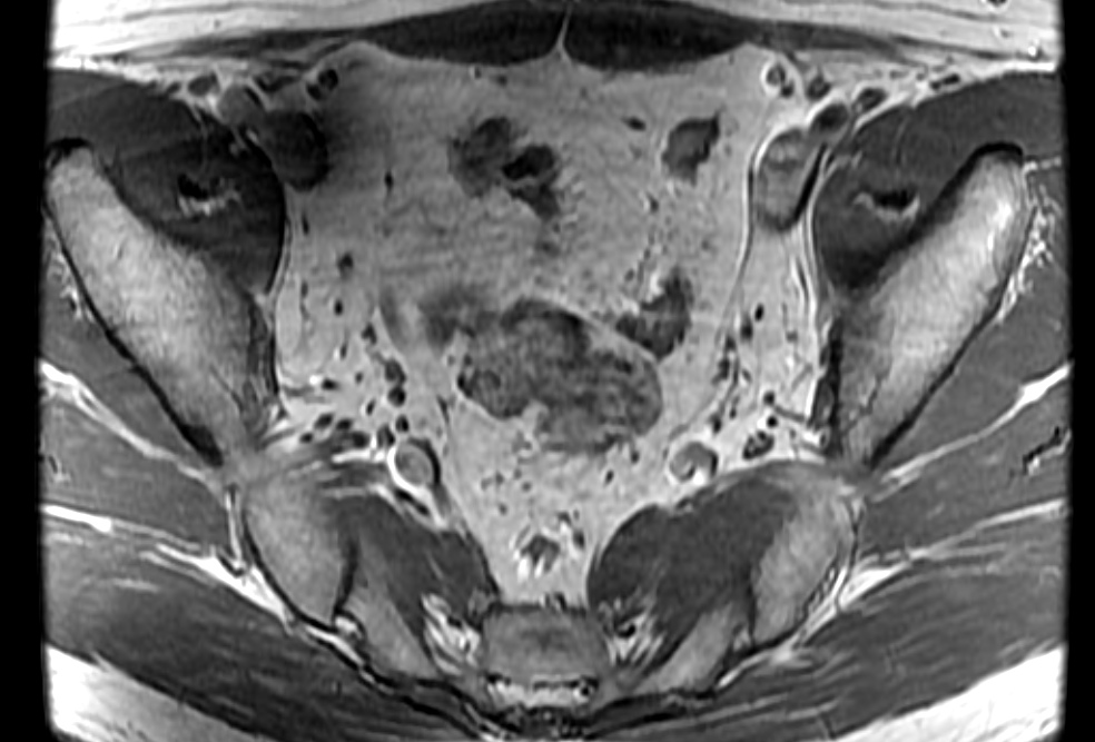 Figure 3 for case Bilateral accessory piriformis muscles